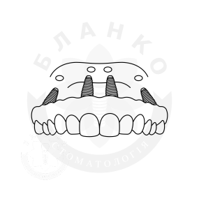 Установка четырёх имплантов «под ключ» при полном отсутствии зубов + несъемная ортопедическая конструкция Установка четырёх имплантов «под ключ» при полном отсутствии зубов + несъемная ортопедическая конструкция