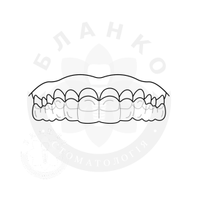 Капи / елайнери для вирівнювання зубів Invisalign Капи / елайнери для вирівнювання зубів Invisalign