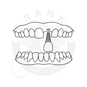 Імплантація переднього зуба (зона посмішки) без кісткової пластики Імплантація переднього зуба (зона посмішки) без кісткової пластики