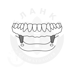 Установка двох імплантів «під ключ» за повної відсутності зубів Установка двох імплантів «під ключ» за повної відсутності зубів