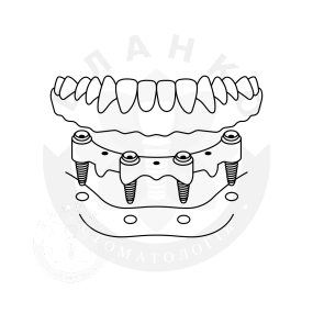 Установка чотирьох імплантів «під ключ» за повної відсутності зубів + незнімна ортопедична конструкція, балкова фіксація Установка чотирьох імплантів «під ключ» за повної відсутності зубів + незнімна ортопедична конструкція, балкова фіксація