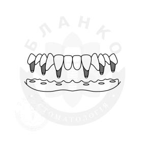 Установка шести імплантів «під ключ» при повному відсутності зубів + незнімна конструкція «оксид цирконію» Установка шести імплантів «під ключ» при повному відсутності зубів + незнімна конструкція «оксид цирконію»