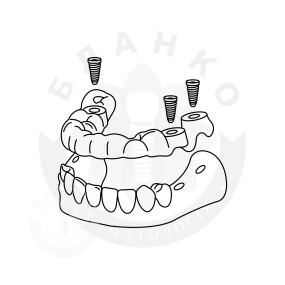 Хірургічні шаблони Хірургічні шаблони